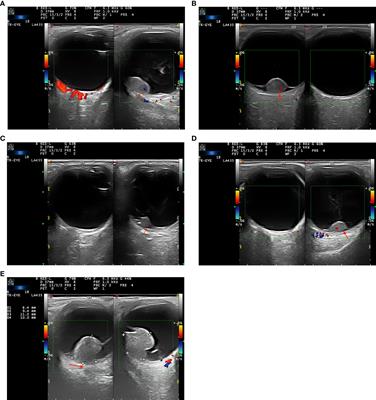 Color Doppler imaging characteristics of RPE neoplasms: A study of 17 cases